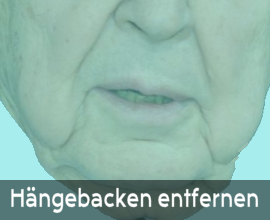 Informationen Hängebacken entfernen